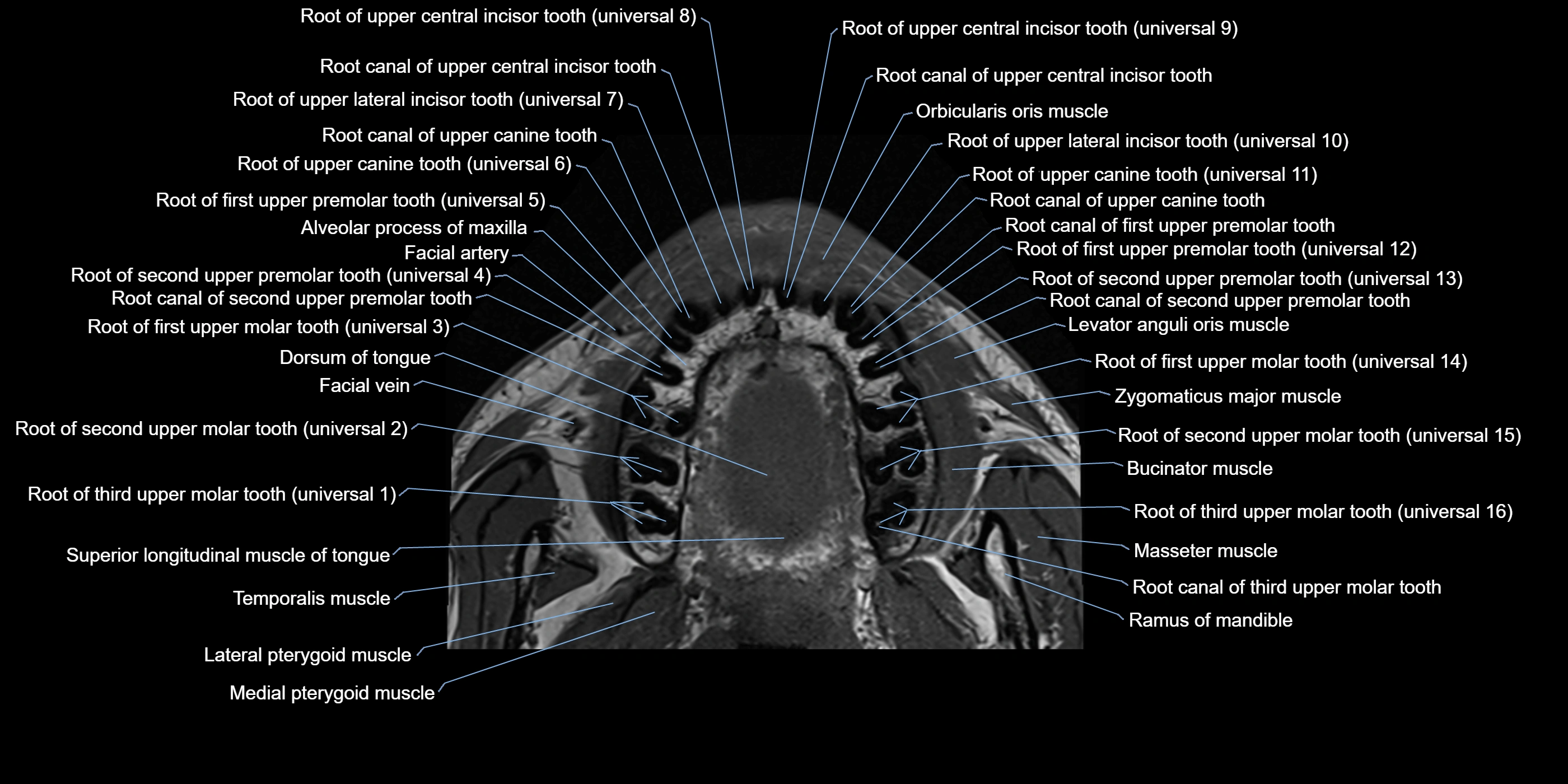 Dental MRI( tooth) axial labelled  cross sectional 3T anatomy -img-00002.webp
